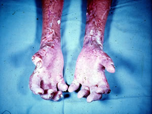 burned hands